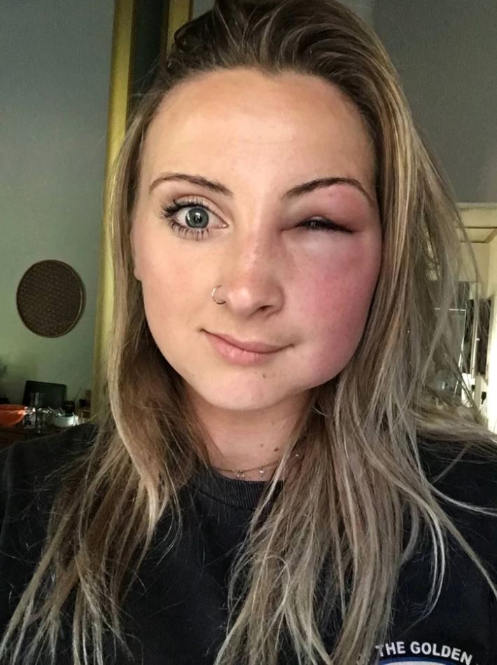 Osoba s opuchnutým ľavým okom a miernym začervenaním v interiéri.