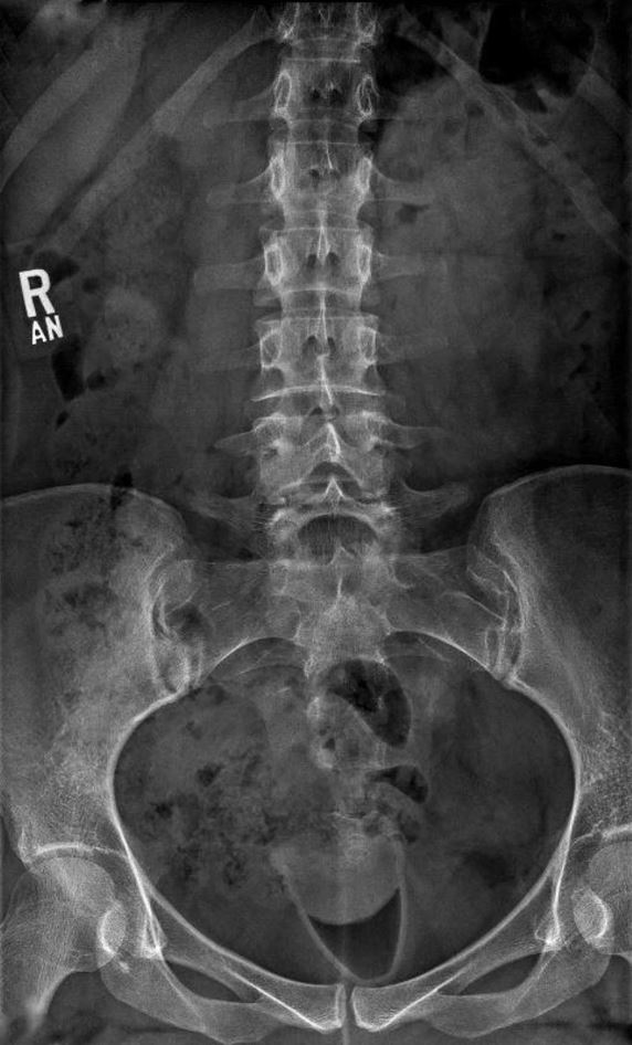 Röntgen bedrovej chrbtice a panvy zobrazuje kostrovú štruktúru v prehľadnej čierno-bielej forme.