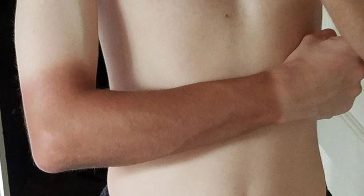 Osoba s opaľovacou čiarou a začervenanou pokožkou na predlaktí drží rukou hrudník.