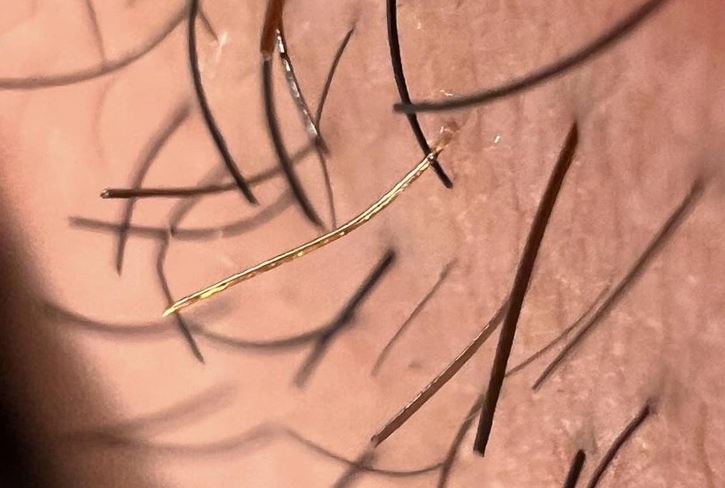 Detailný záber na ľudské chlpy s jedným výrazným zlatým chlpom na pokožke.