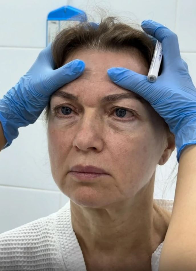 Žena v bielom s rukavicami drží čelo, pripravená na kozmetický úkon; klinické prostredie.