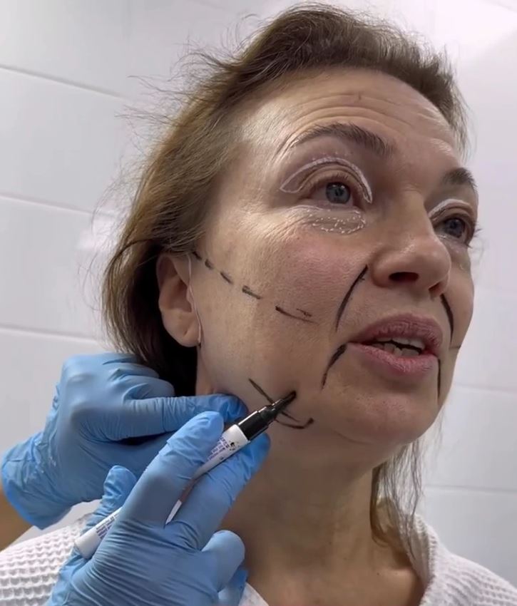 Žena s predoperačnými značeniami na tvári, chirurg plánuje facelift v sterilnom prostredí, rukavice a značkovač.
