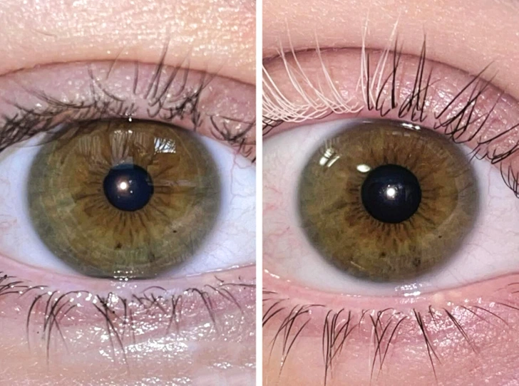 Detailné zobrazenie ľudského oka, dve fotografie: pred a po zväčšení zrenice.