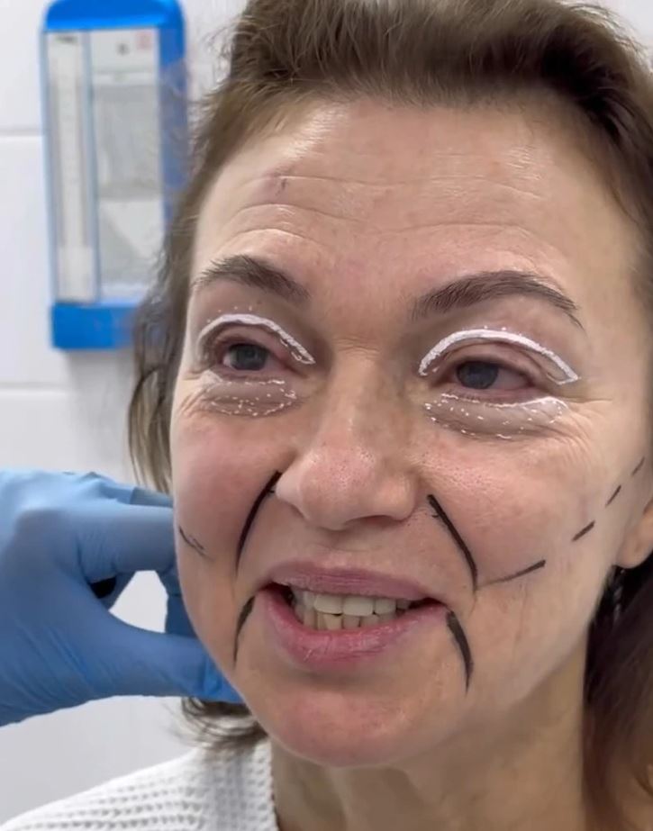 Žena pred kozmetickým zákrokom s markermi na tvári v ordinácii.