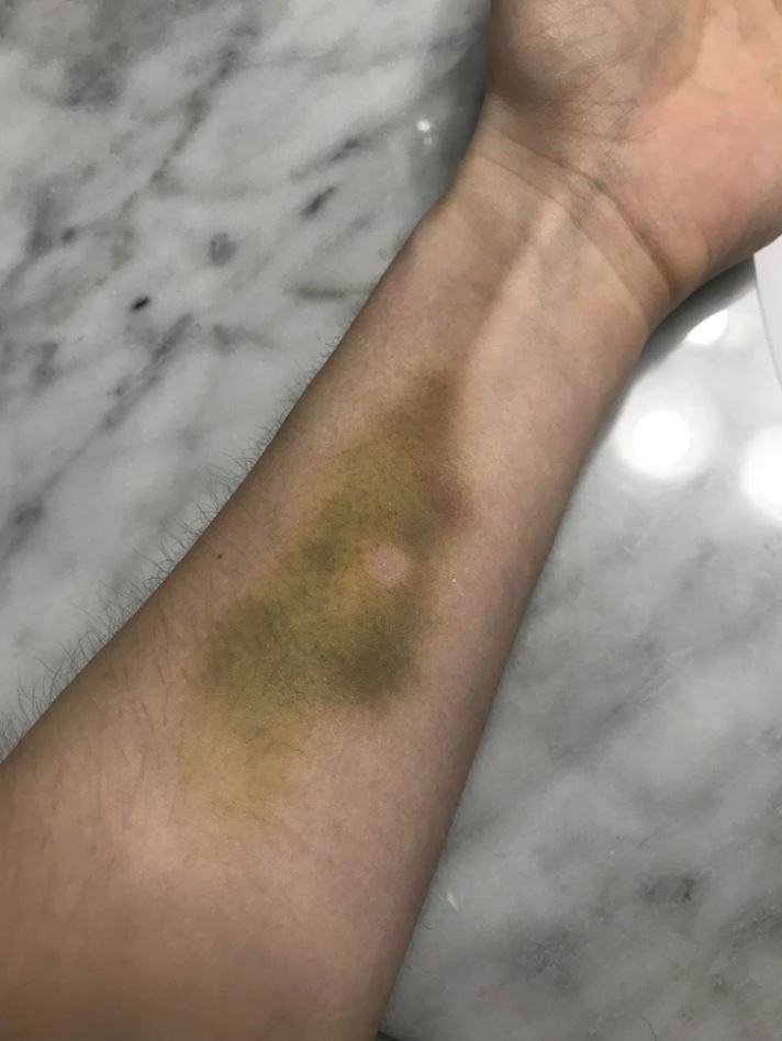 Ruka s farebnou modrinou na predlaktí položená na mramorovom povrchu, viditeľné detaily pokožky.