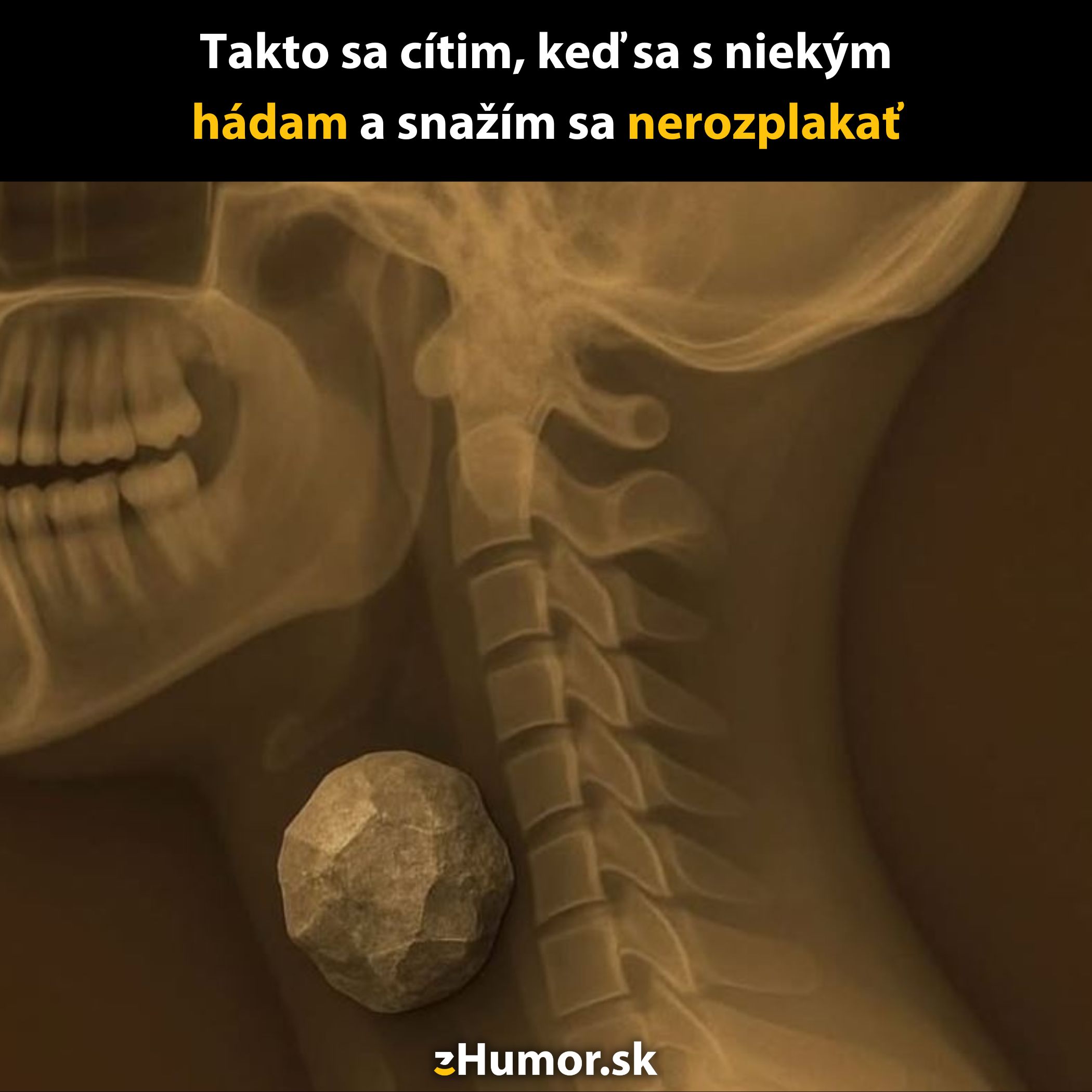 RTG snímka krku s veľkým kameňom v hrdle, výstižne ilustrujúca pocit pri emocionálnom napätí.