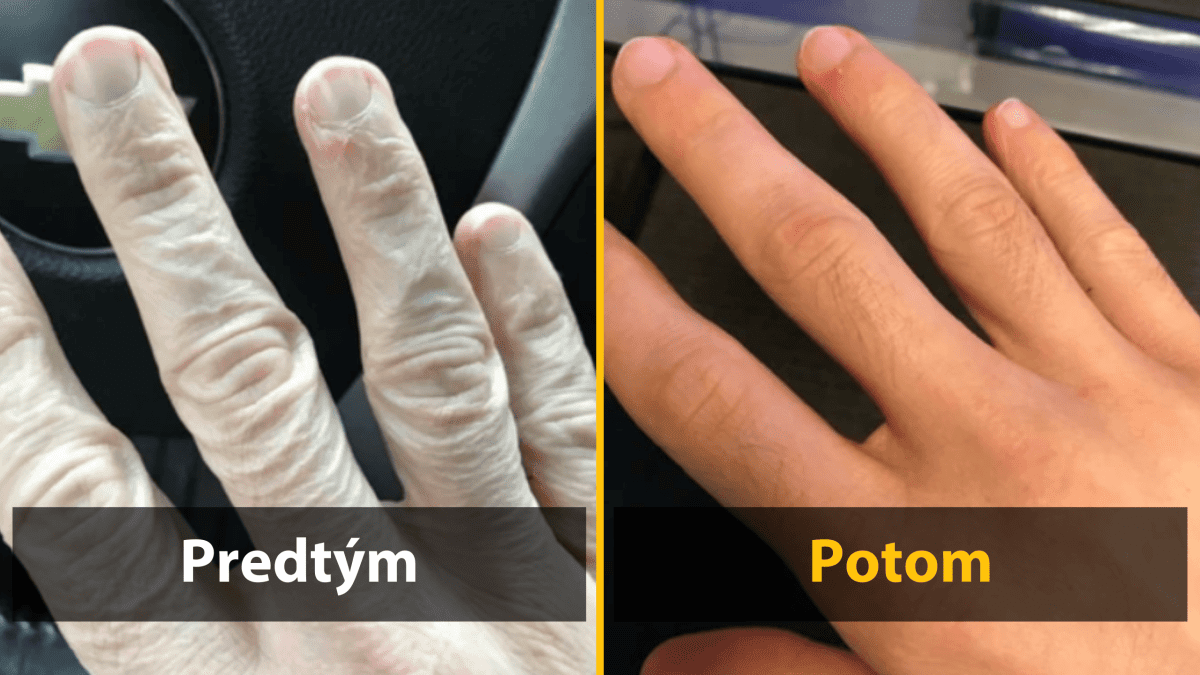 Ruky pred a po hydratácii: výrazné zlepšenie pokožky po použití krému.