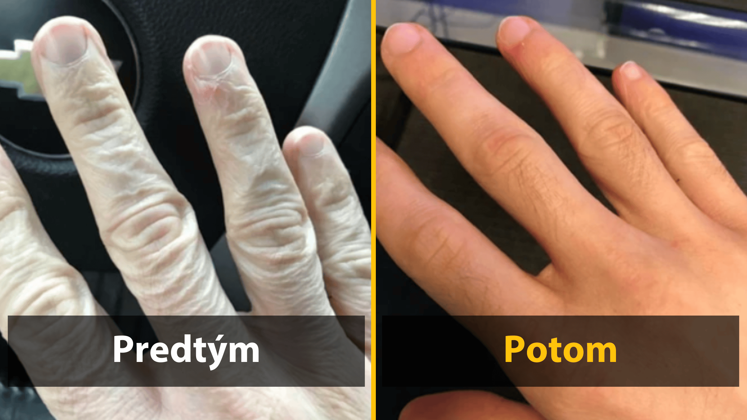 Ruky pred a po hydratácii: výrazné zlepšenie pokožky po použití krému.