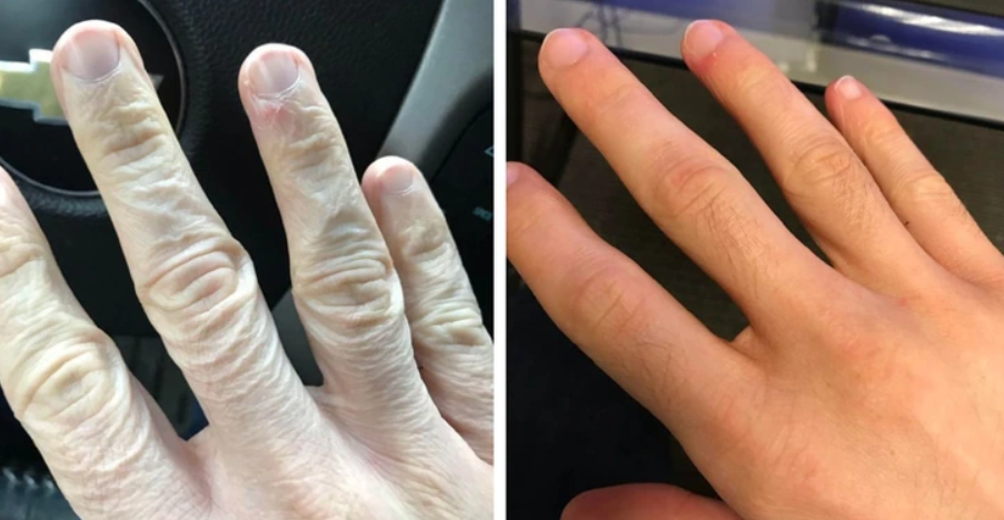 Dve fotografie rúk, porovnanie zdravej pokožky a pokožky s kožným problémom, zvýrazňujú rozdiely v hydratácii.