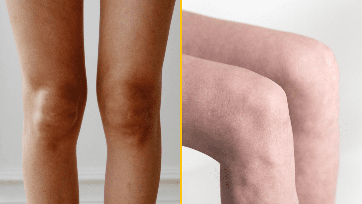 Porovnanie opálených a neopálených kolien: rozdiely v tóne a textúre pokožky.