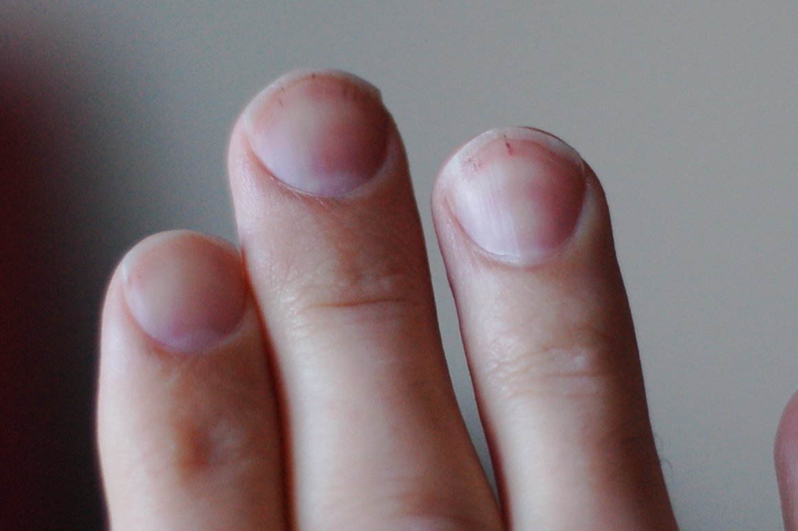 Ruky s poškodenými nechtami, detailný záber na prsty, problém ohrýzania nechtov.