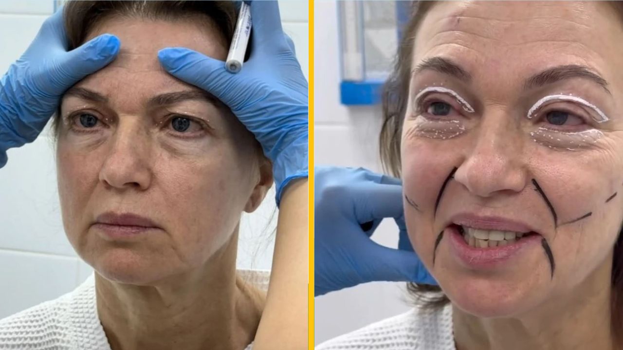 Žena na kozmetickej konzultácii s modrými rukavicami, nakreslené línie na tvári pre plánovanie zákroku.