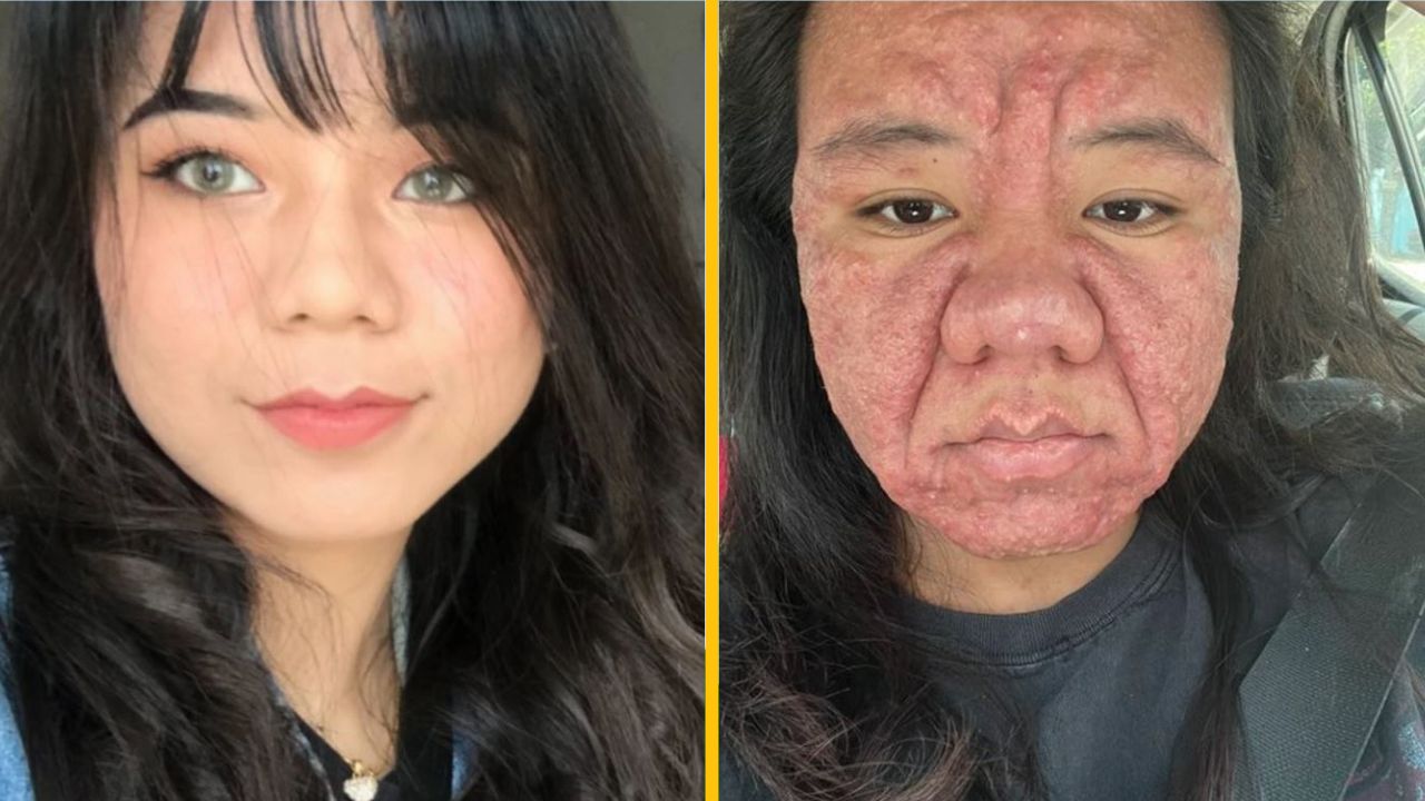 Dva kontrastné portréty ženy: jeden so zdravou pokožkou, druhý s vážnym kožným stavom.