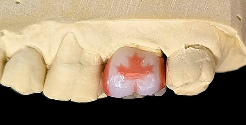Zubná korunka s obrázkom červeného javorového listu na modeli chrupu – detailná ukážka zubnej protetiky.