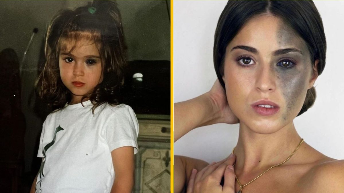 Dievča s dlhými vlasmi v bielej košeli a dospelá žena s tmavou škvrnou na tvári. Porovnanie z detstva a dospelosti.