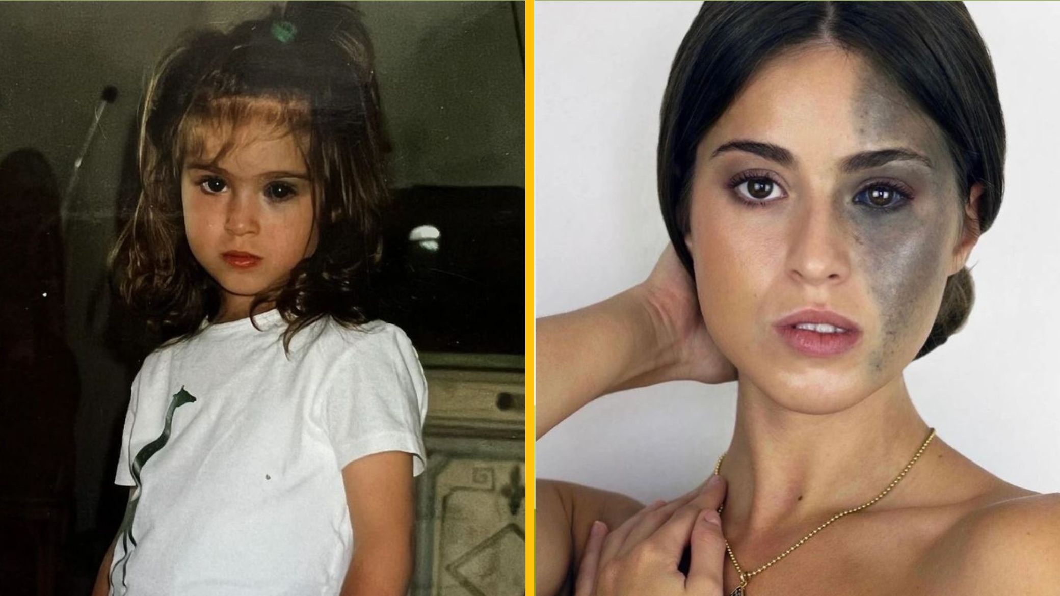 Dievča s dlhými vlasmi v bielej košeli a dospelá žena s tmavou škvrnou na tvári. Porovnanie z detstva a dospelosti.