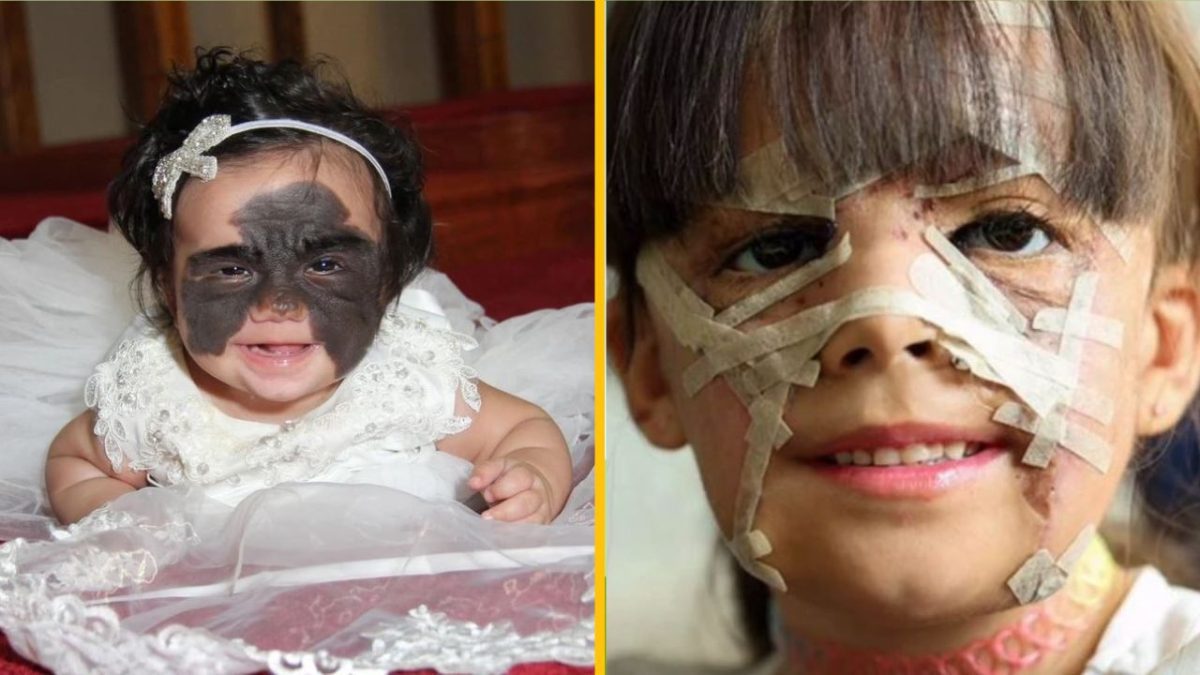 Dieťa s vrodeným znamienkom na tvári, vedľa toho po chirurgickej liečbe, úsmev a náplasť na pokožke.