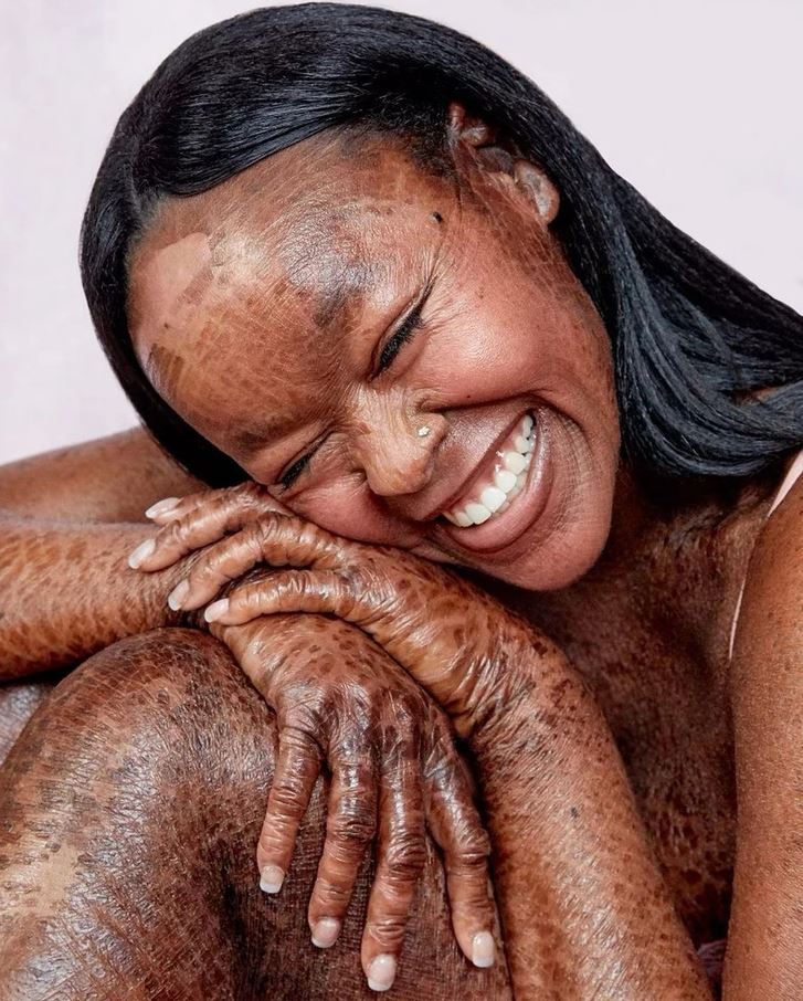 Osoba s úsmevom a tmavými vlasmi s unikátnou textúrou pokožky v detailnom zábere.