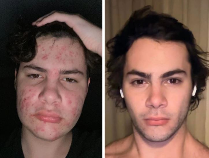 Osoba pred a po ošetrení pleti, zlepšenie vzhľadu tváre.