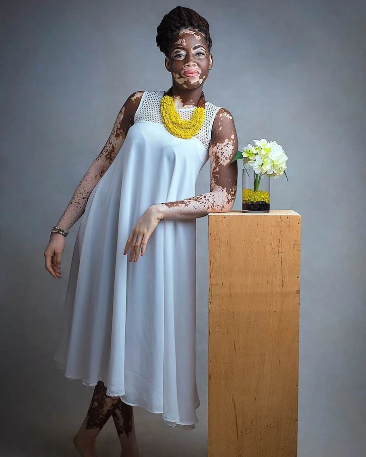 Móda a elegancia: Žena v bielych šatách s vitiligom pózuje pri kvetinovej dekorácii v ateliéri.