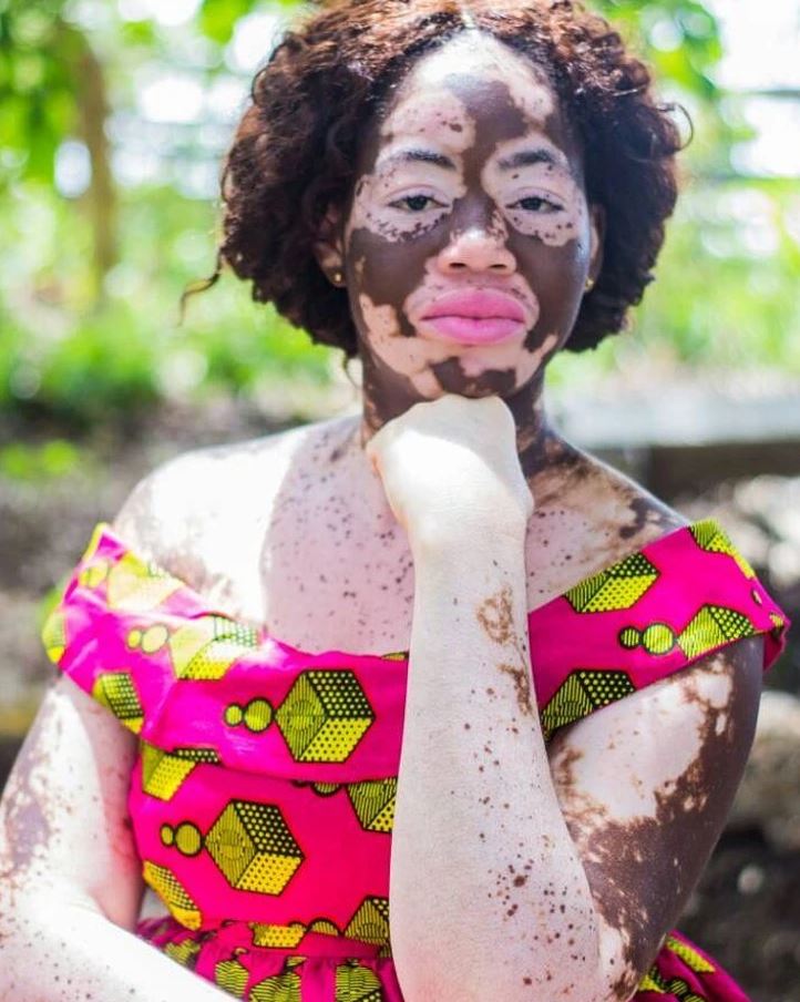 Žena vo farebných šatách s vitiligom sedí vonku, pózuje a usmieva sa pri prírodnom osvetlení.