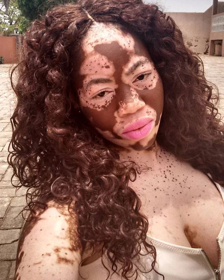 Osoba s vitiligom a kučeravými vlasmi sa usmieva vonku na slnečnom dvore, oblečená v svetlom oblečení.