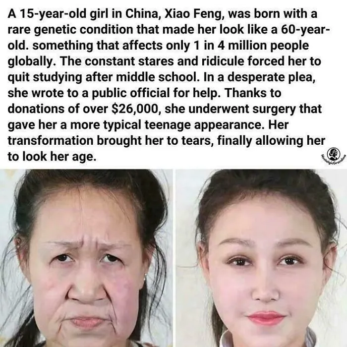 Pred a po: Mladá čínska dievčina po úspešnej operácii zmenila vzhľad z dôvodu zriedkavej genetickej choroby.