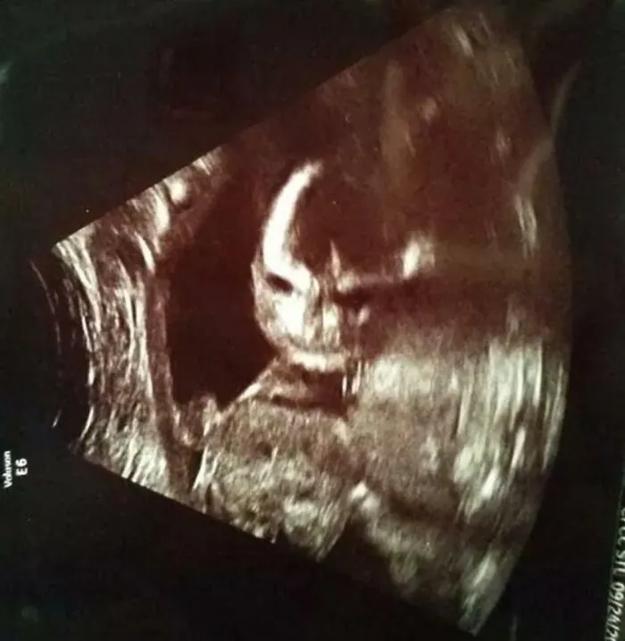 Neznámy ultrazvukový obrázok plodu v maternici, zachytený počas lekárskeho vyšetrenia.