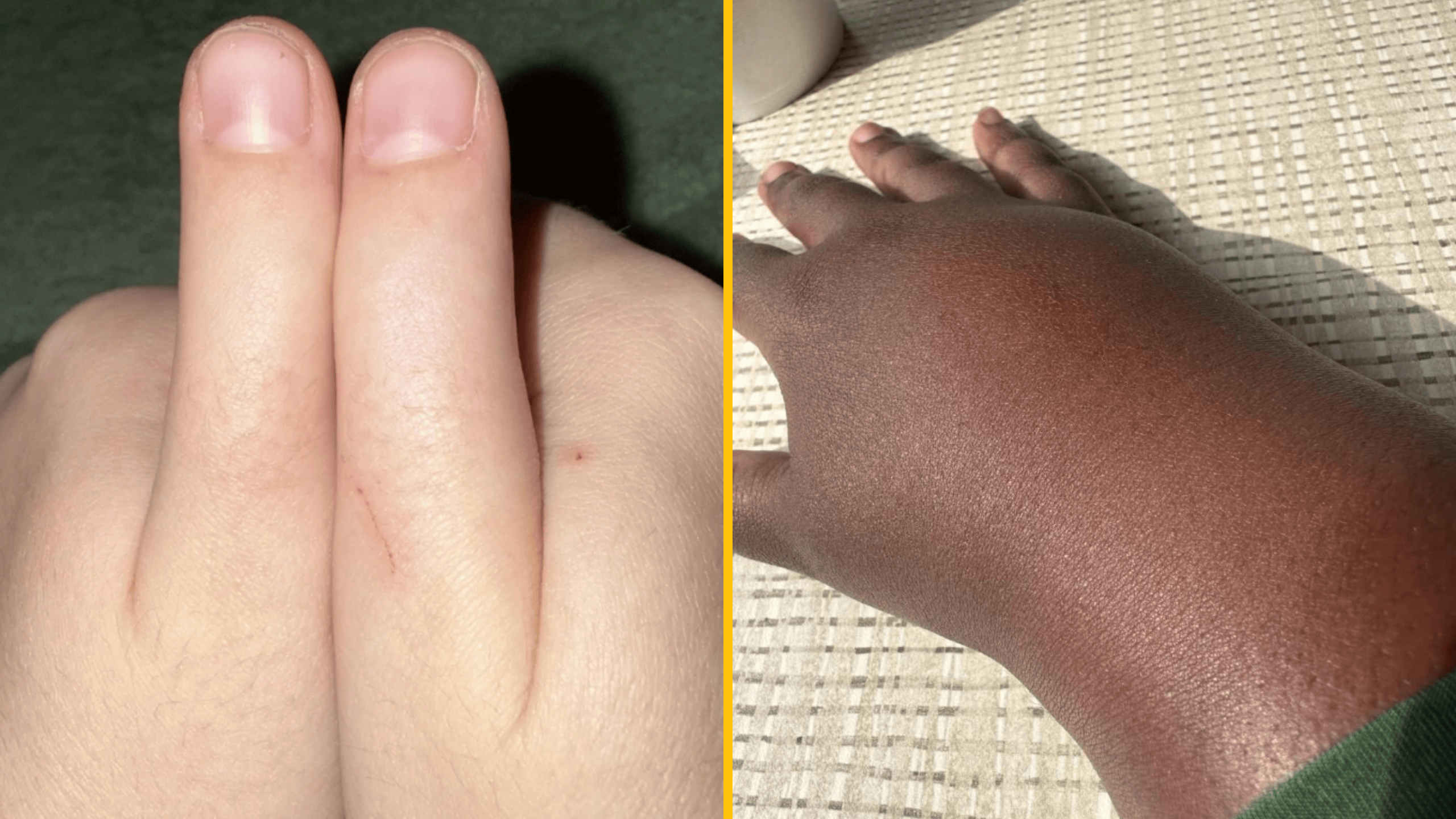 Dva ruky vedľa seba ukazujú rozdiely v odtieni pokožky na zelenom a krémovom pozadí.