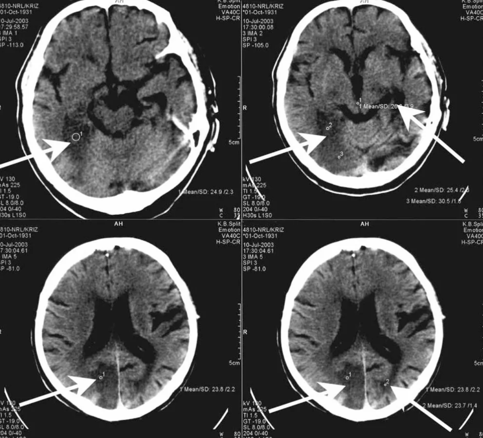 CT snímky ľudského mozgu so zobrazenými šípkami indikujúcimi vyšetrovacie body.