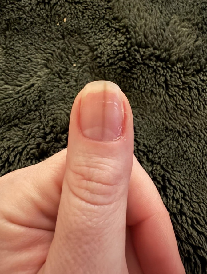 Palec s priehľadným nechtom a zvislou ryhou na tmavom pozadí.