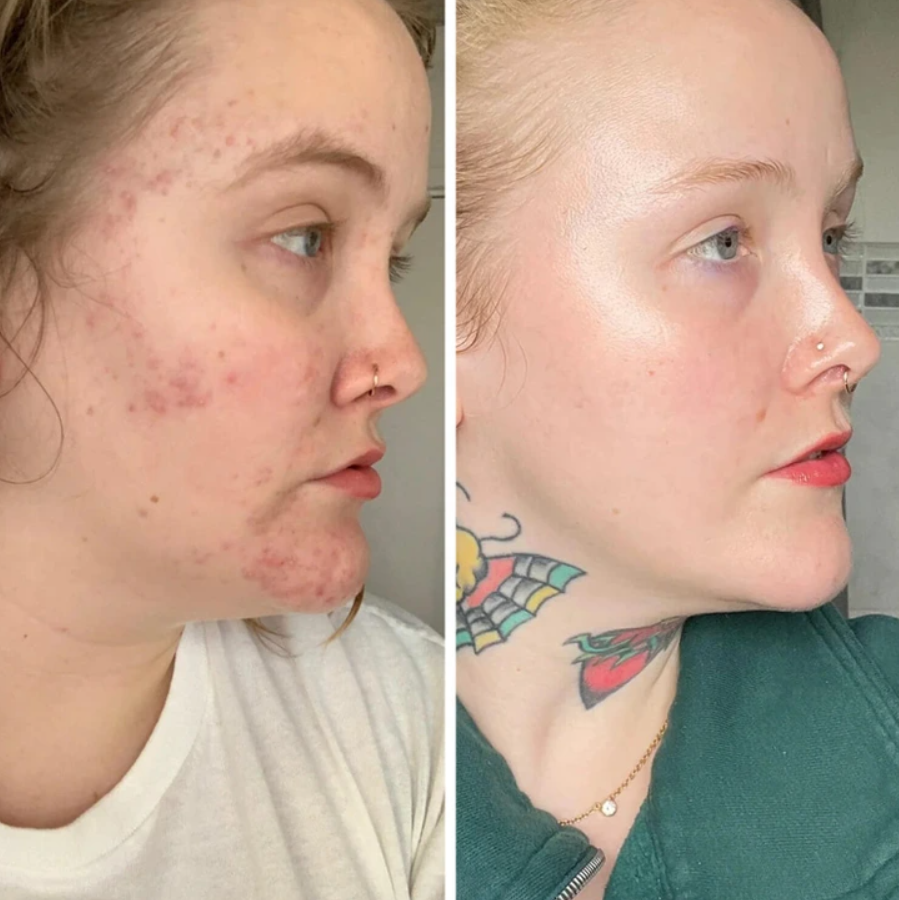 Pred a po: Porovnanie stavu pokožky pred a po ošetrení akné, zlepšenie viditeľné.