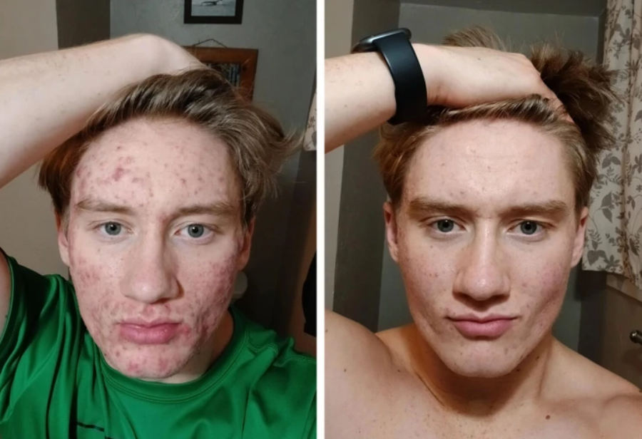 Porovnanie mladíka pred a po zlepšení pleti, ukazuje pozitívnu zmenu stavu pleti.