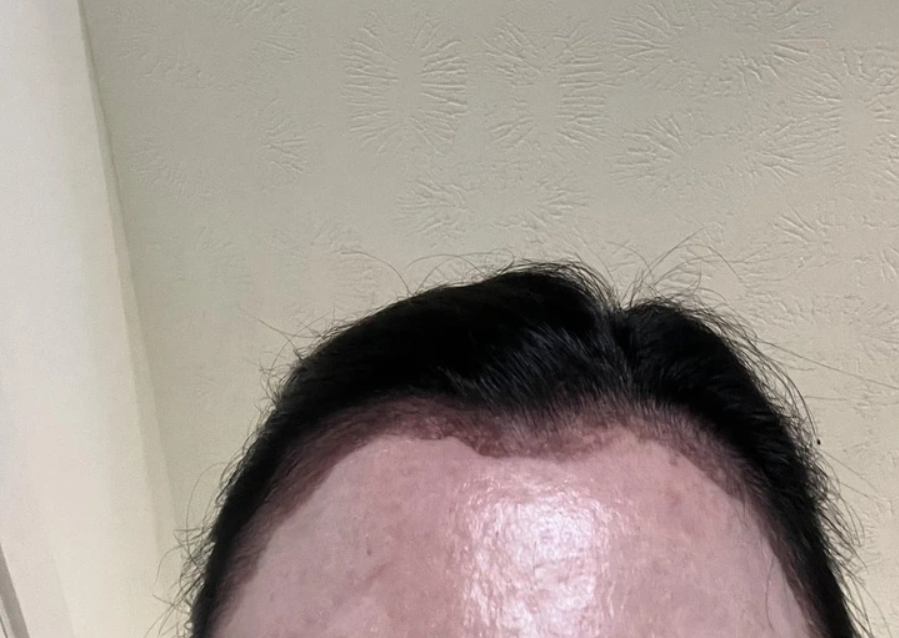 Osoba s tmavými vlasmi a svetlou pokožkou, pohľad na čelo a vlasy v interiéri s krémovou stenou.