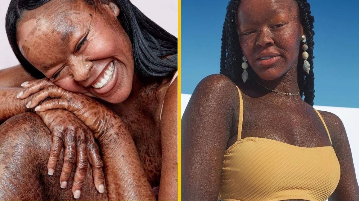 Usmievavá žena s kožnou odlišnosťou, pózujúca v žltých šatách a prírodnom svetle.