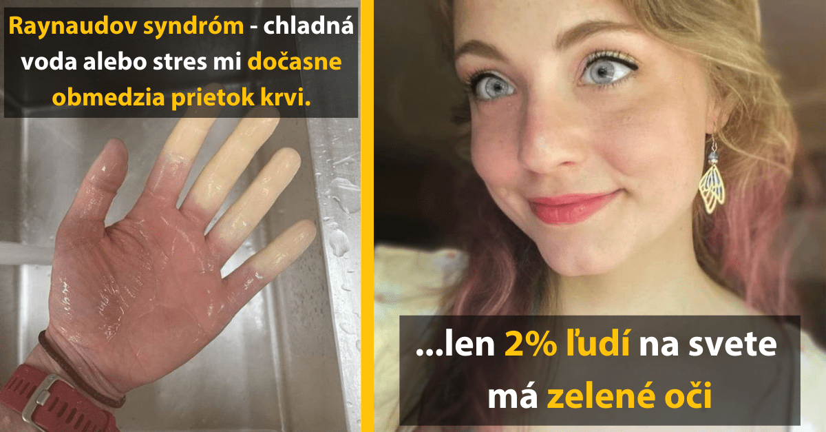 Ruka s Raynaudovým syndrómom a žena so zelenými očami - vzácnosti života.