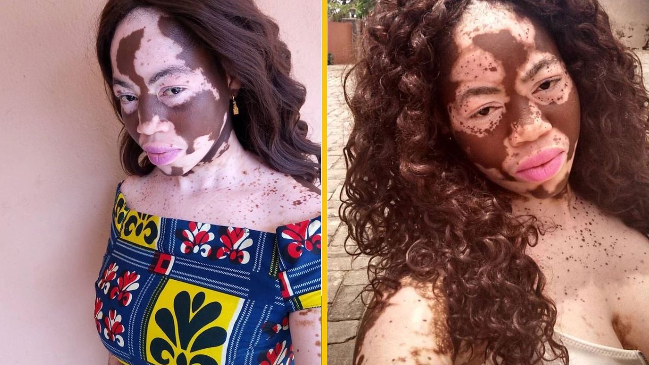 Žena s vitiligom ukazuje svoju jedinečnosť na dvoch snímkach, s rôznymi účesmi a výrazným líčením.