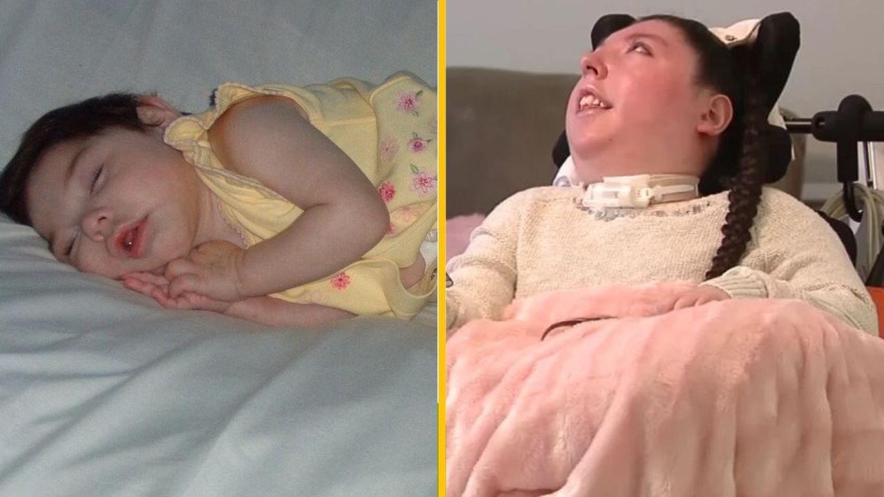 Narodila sa bez mozgu a dali jej len 4 roky života – dožila sa svojich 20 rokov