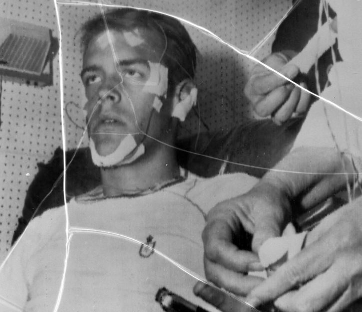 Muž pripojený na meracie prístroje počas lekárskeho vyšetrenia elektroencefalogramom v čierno-bielom zázname.