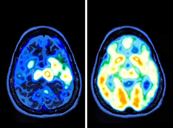 Mozgové snímky z PET skenovania ukazujú rozdielnu aktivitu medzi dvoma stavmi mozgu.