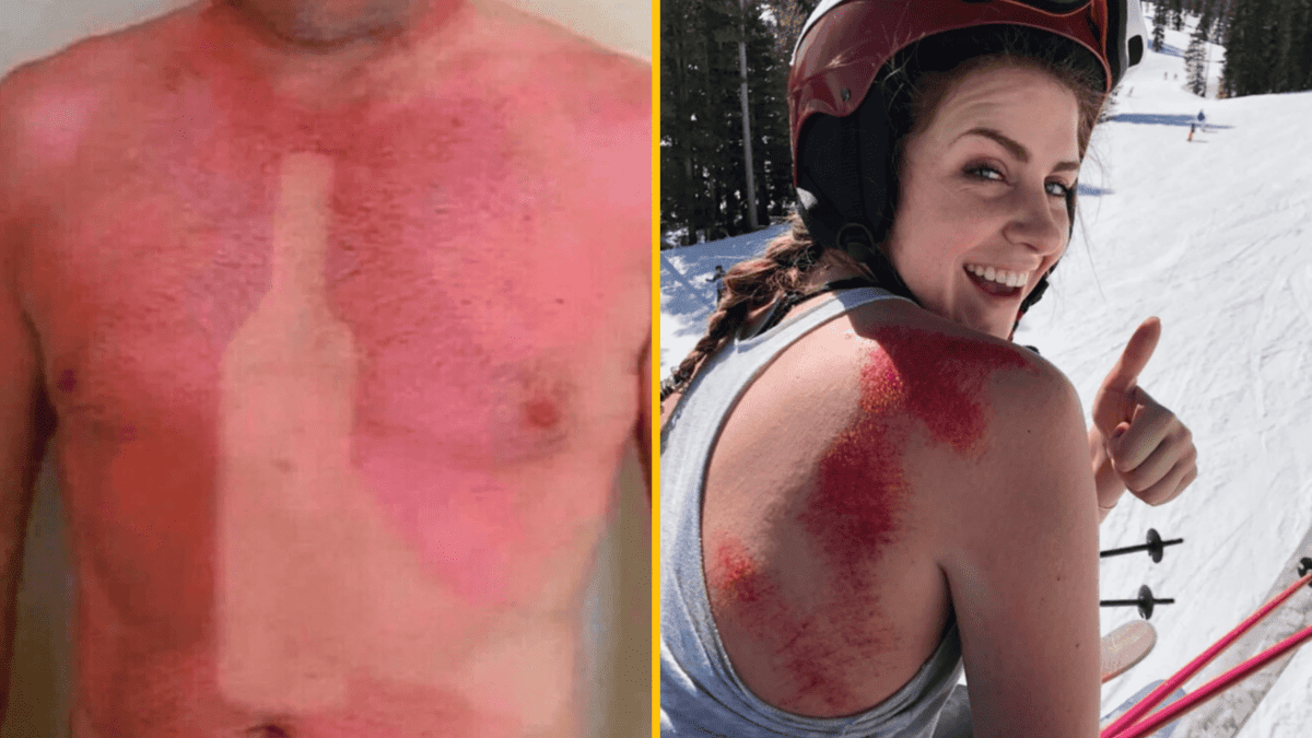 Dva prípady spálenia pokožky slnkom, človek na pláži a lyžiarka s úsmevom a slnečnými okuliarmi.