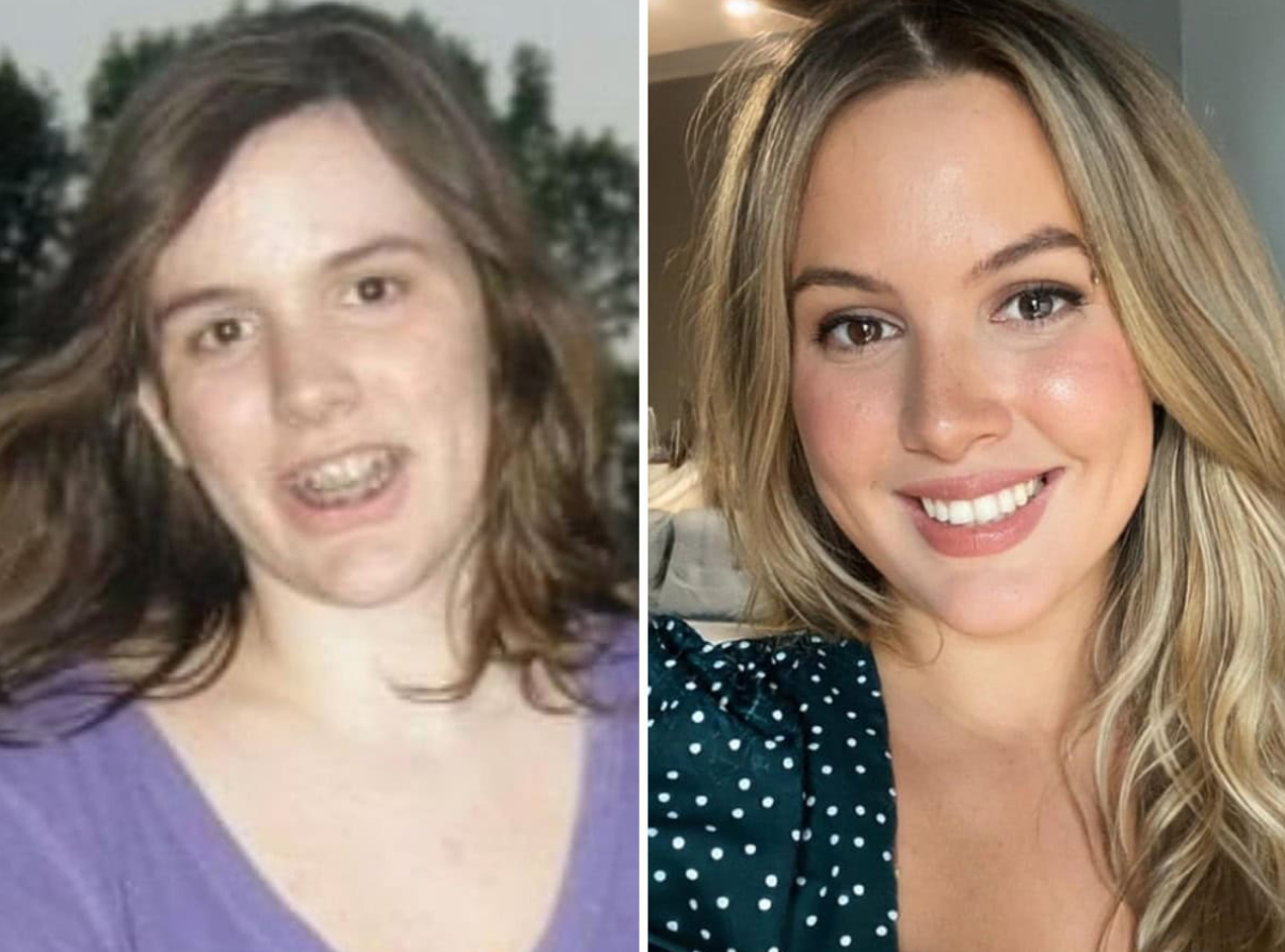 Pred a po premene: Fotografia ukazuje viditeľnú premenu mladšej a staršej ženy so zreteľným rozdielom vo vzhľade.