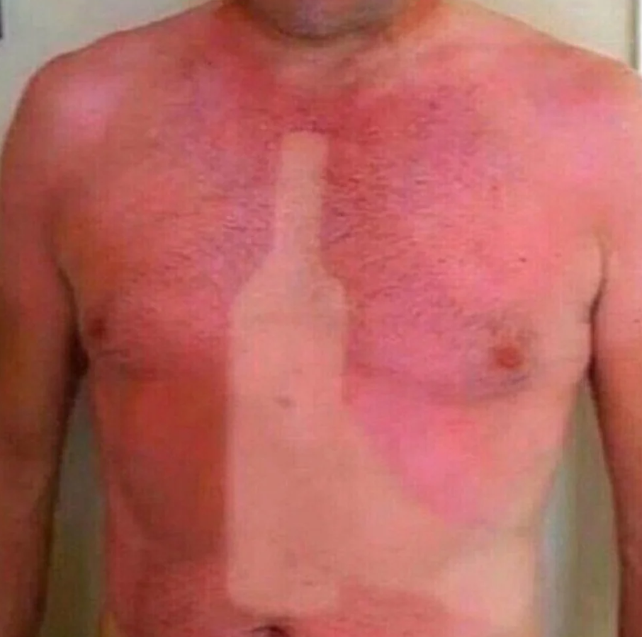 Osoba so spálenou pokožkou na hrudi, kde zostal svetlý odtlačok fľaše.