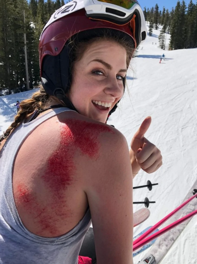 Lyžiarka s úsmevom a odřeným ramenom ukazuje palec hore na zasneženej zjazdovke.