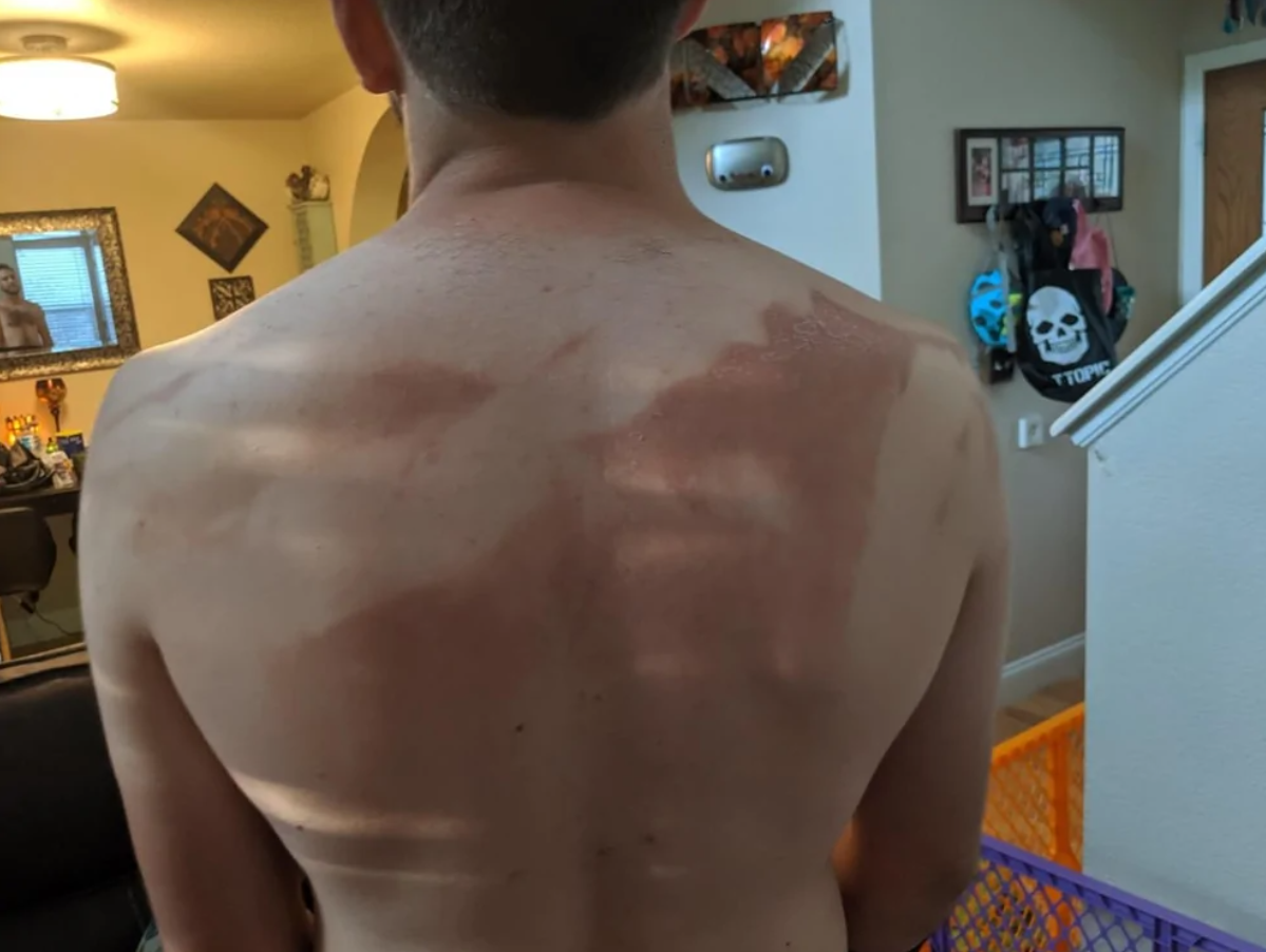 Chrbát človeka so spálenými miestami od slnka v obývacej izbe, okolité predmety naznačujú každodenný život.