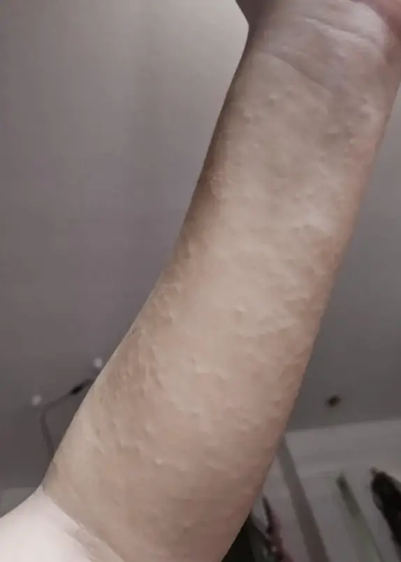 Neviem, koho je to ruka, ale je na nej vidieť krupičková pokožka.