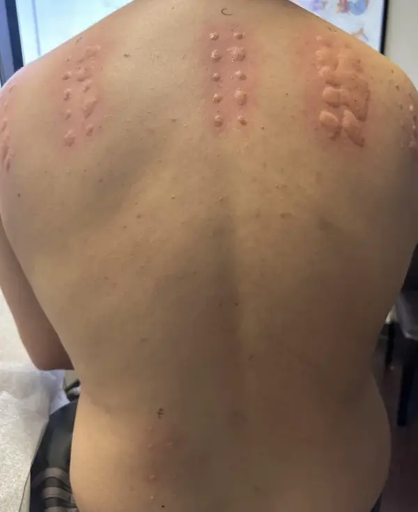 Označkované jazvy na chrbte po tetovaní alebo kožnej procedúre v procese hojenia.