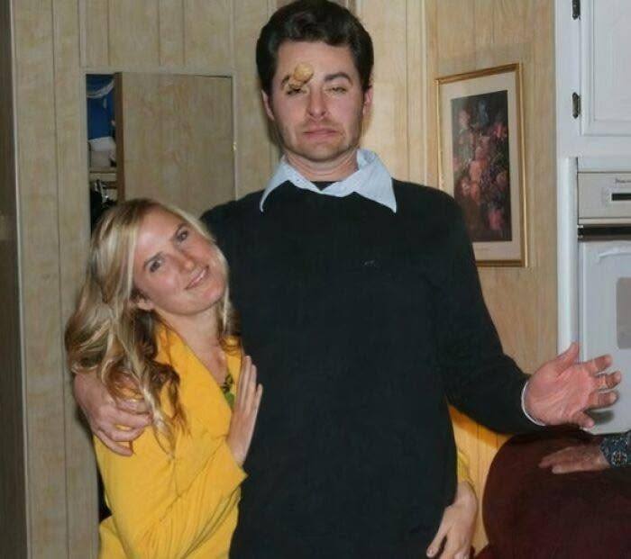 Osoba s arašidovou krustou na tvári, objímaná ženou v žltej bunde, stojaci v interiéri s drevenými stenami.