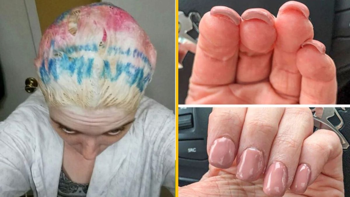 Žena s farebným melírom na vlasoch, poškodenou kožou na prstoch a upravenými nechtami, krása a starostlivosť o telo.