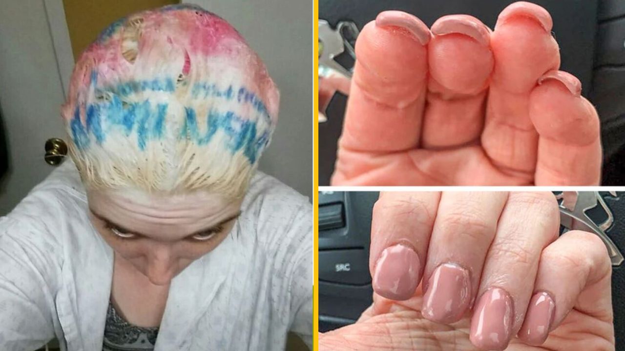 Žena s farebným melírom na vlasoch, poškodenou kožou na prstoch a upravenými nechtami, krása a starostlivosť o telo.